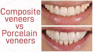 Composite veneers vs Porcelain veneers