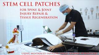 Stem Cell Anchoring for Disc Injury & Spine Facet Joint Arthritis Cartilage: Stem Cells + PRF Repair