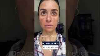 Zo 3-Step Peel.. crazy peeling for your face!