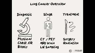 Doctor Explains What to Expect with New Lung Cancer Diagnosis