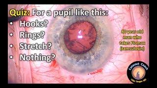 Cataract Surgery Quiz: For a pupil like this, what is your approach?