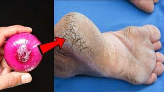 Remove Cracked Heels and Get Beautiful Feet Permanently - Magical Cracked Heels Home Remedy