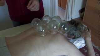 Cupping: a chinese medical approach to healing .mov