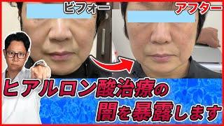 ヒアルロン酸注射でほうれい線やシワやたるみが解消！しかし、その裏には闇もあります