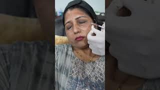 Botox for Forehead Wrinkles | Botox injection | Botox treatment #shorts