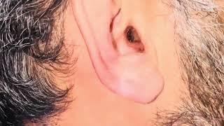 Removal of a PILL BUG get lodged deep in the Ear during gentleman’s fast sleep.