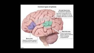 Types of Aphasia #aphasia #broca'sarea #area45