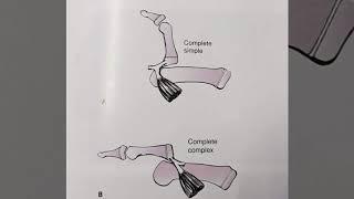 METACARPOPHALANGEAL DISLOCATION THUMB