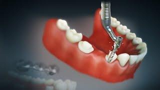 Dental Bridge and Crown | Fixed Bridge | Fixed Dental Replacement