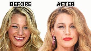 Blake Lively's Plastic Surgery Procedures: The Face She Deserves? (2024)