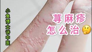 68. 荨麻疹的治疗