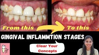 GINGIVITIS ‖ Stages Of Gingival Inflammation ‖ Perio Hub ‖ Dr Sneha