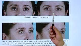 Non Surgical Blepharoplasty Procedure Beverly Hills