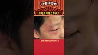 大家一定要小心这个隐翅虫啊！！！#隐翅虫 #危险 #娱乐评论 #娱乐评论  #shorts