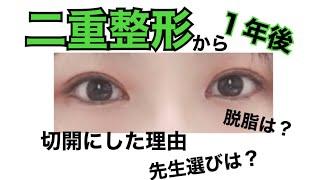 二重整形レポート3！切開から１年経過。脱脂しなくても二重になれる！　全切開のダウンタイム終了です