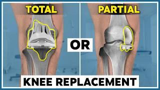 Partial or Total knee replacement - How to chose the right knee replacement