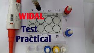 Widal Test Practical | Widal test for typhoid | Typhoid test in hindi | Typhoid ke liye test | विडाल