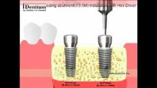 Dentium implantátum behelyezés / animáció /