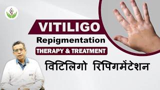 Vitiligo Repigmentation (विटिलिगो रिपिगमेंटेशन) Therapy & Treatment | Care Well Medical Centre