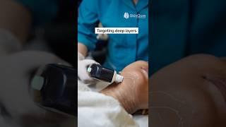 Double Chin Reduction With HIFU (High-Intensity Focused Ultrasound) Treatment | #shorts