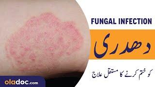 How To Remove Fungal Infection Urdu Hindi- Daad/Dadri Ka Ilaj - Ringworm Removal - Chambal Ka Ilaj