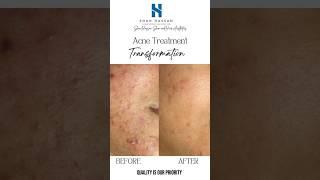 Shah Hassan Skin & Hair Aesthetics #viralshorts #melasma #skincareproducts #glowingskin #hydrafacial