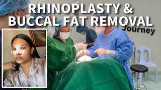 MY RHINOPLASTY AND BFR Journey Part 1, Experiences during the surgery | Kim Rosanto