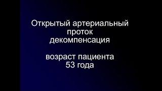 Открытый артериальный проток в ст. декомпенсации, возраст пациента 53 года