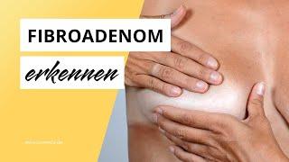 Gutartiger Brusttumor: So erkennst Du ein Fibroadenom