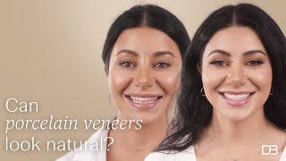 Porcelain Veneers...can they look natural? | Dental Boutique™