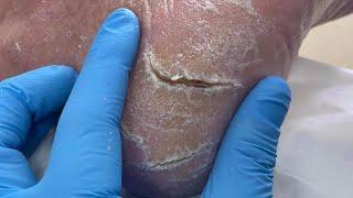 Dry And Cracked Soles To Remove Thick Dead Skin【Pedicure Master Lin Jun】