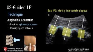 Ultrasound-Guided Lumbar Puncture