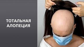 Тотальная алопеция