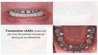 Эстетическая реставрация - несъемное протезирование зубов на имплантах