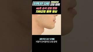 40초 치아교정 [비발치, 주걱턱교정 전후 변화 순삭영상]