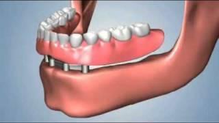 edentulismo completo, opciones fija total sobredentadura.flv