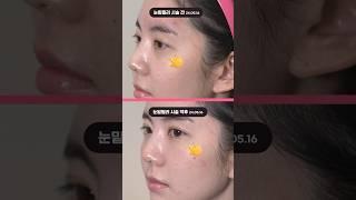 #눈밑꺼짐  필러로 자연스럽게 해결하세요 