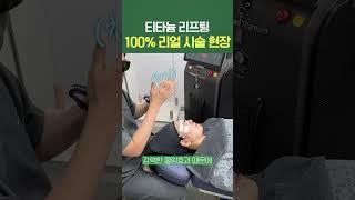 #티타늄리프팅 100% 리얼 시술현장 #shorts