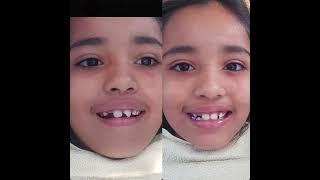 Dental Trauma Childs Broken, Fractured Tooth Repair With Tokuyama Omnichroma Restoring Divine Smiles