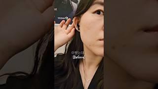 토론토에서 켈로이드 제거 수술 전 후. 깰꼼  post Keloid scar removal surgery