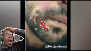 HE NEEDS TO SEE A DOCTOR ABOUT THIS CYST! | CRAZY CYST PIMPLE POPPING