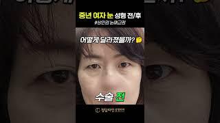 중년 여자 상안검 눈매교정 성형 후기, 수술 전후 비교 #여자쌍수 #눈매교정 # 쌍수전후 #상안검 #중년여자 #수술전후 #성형전후 #성형후기