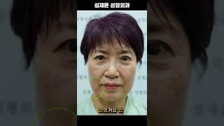 안면거상 10일 차에 회복정도 ? 경과를 체크해봤습니다! #korean #리프팅효과 #skincare #안면거상