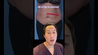 Watch This Tummy Transformation! #shorts #tummytuck