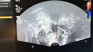 полип эндоцервикса. начинающим врачам УЗД. endocervix polyp