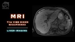 MRI – T1w VIBE Dixon w/CAIPIRINHA – Liver Imaging