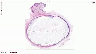 Epidermal Inclusion Cyst (Atheroma) - Histopathology