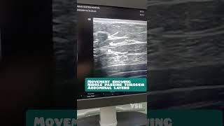 usg guided TAP block | anesthetia block for pain relief #shorts #youtubeshorts #viral