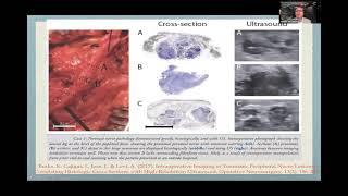 Ultrasound-Guided Regenerative Interventions on Neuropathic Pain: An Update by Dr. Jeimylo De Castro