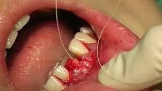 Failed Implant - Bone Augentation, Allograft, Col.Membrane & Sub Epithelium Connective Tiisu graft